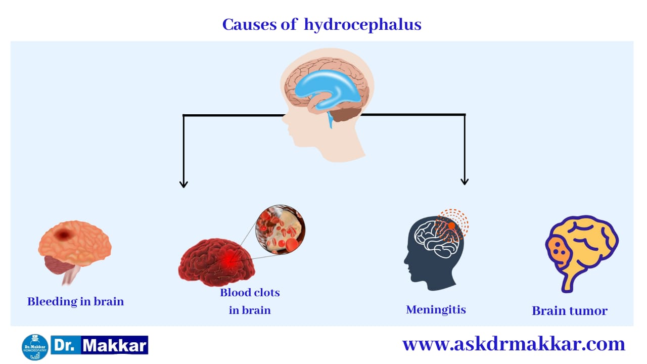 Hydrocephalus | Symptoms | Causes | Medicines | Homeopathic Treatment